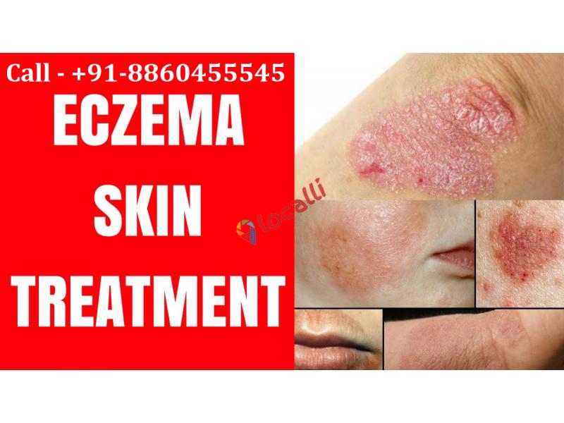 Call :: 8860455545 :: Eczema skin treatment in Barhaj
